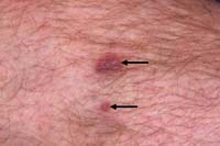 Kaposi's Sarcoma